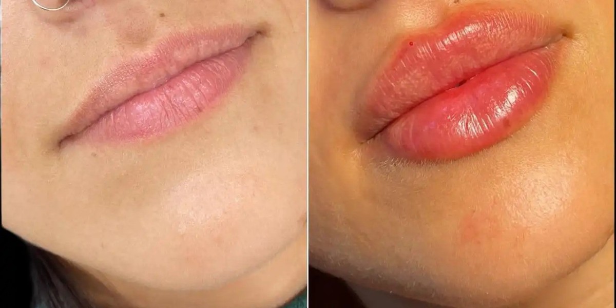 Best Aesthetic Clinic in dubai for Cost Effective Fillers