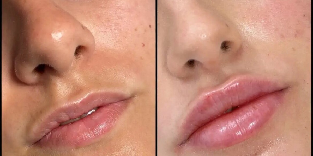 Fillers Treatments in Dubai for Premium Aesthetic Rejuvenation