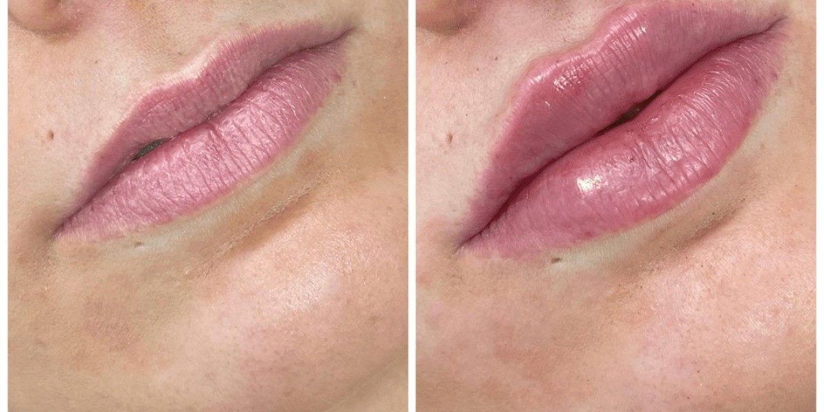 Facial Harmony Achievements Through Juvederm and Best Doctors in Dubai