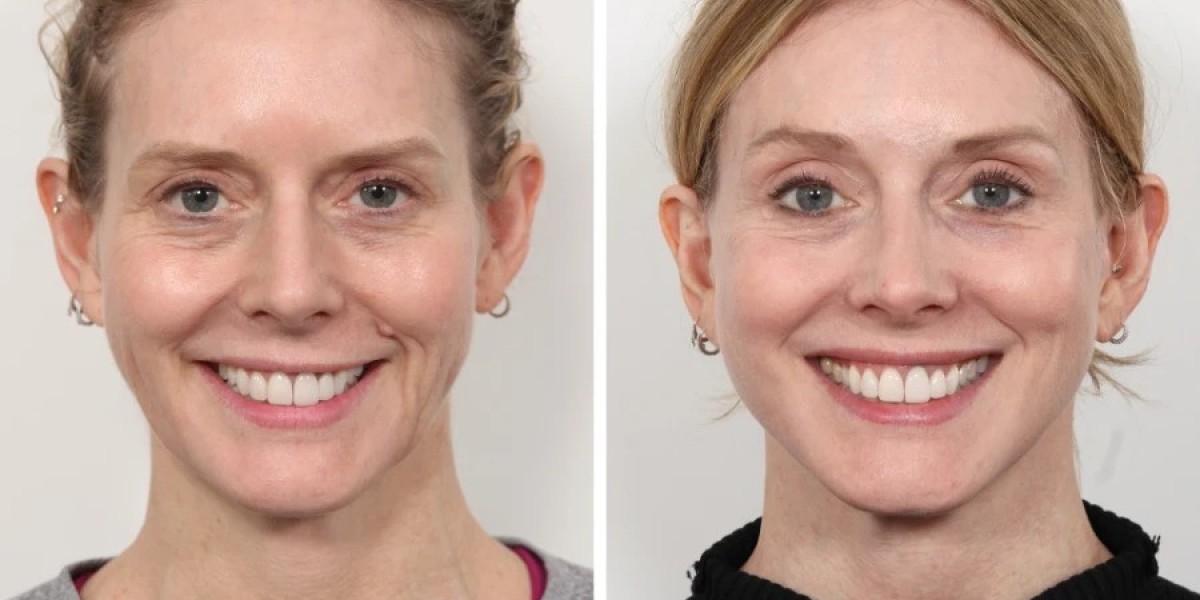 Thread Lift in Dubai: Benefits, Procedure, Results, and Recovery