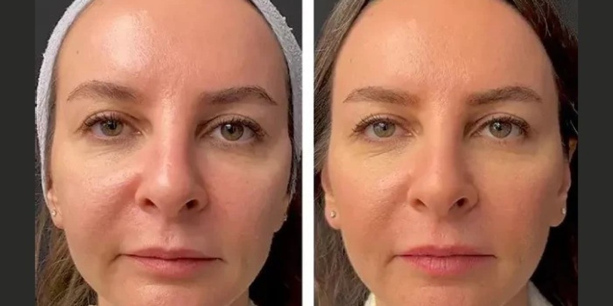 Mesotherapy Treatment in Dubai: Benefits for Glowing and Radiant Skin