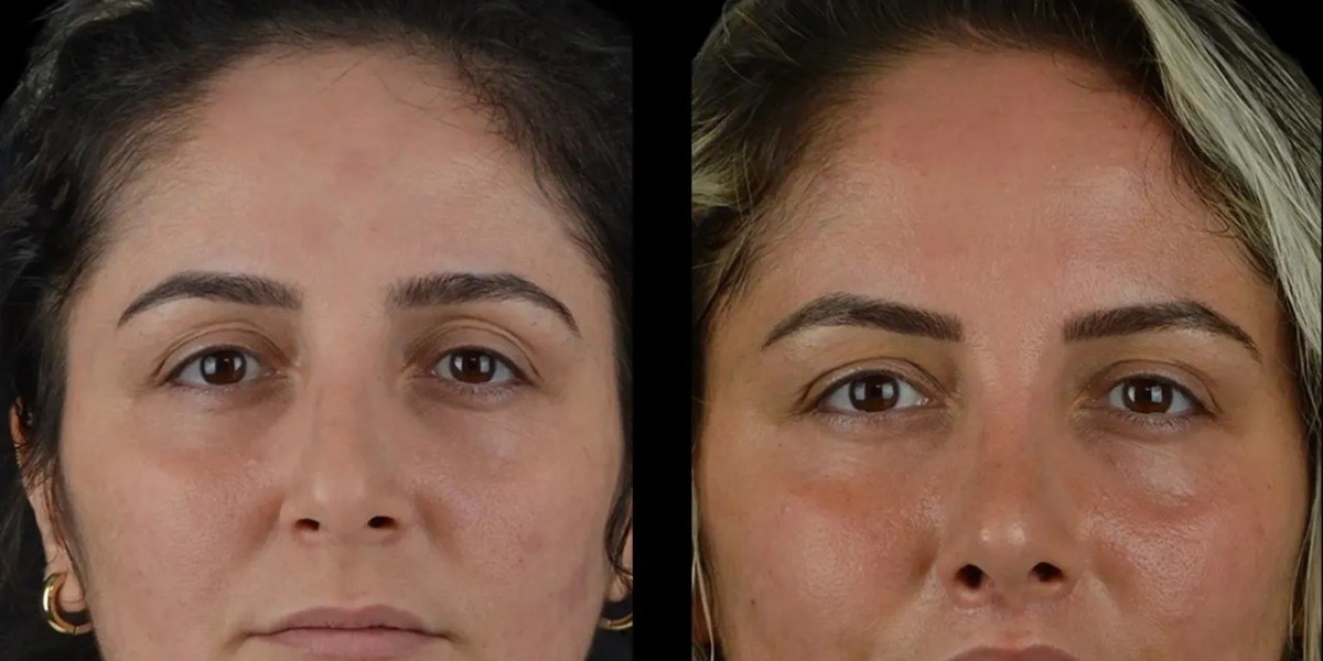 Cheek Fillers Future Trends Best Aesthetic Clinic in Dubai