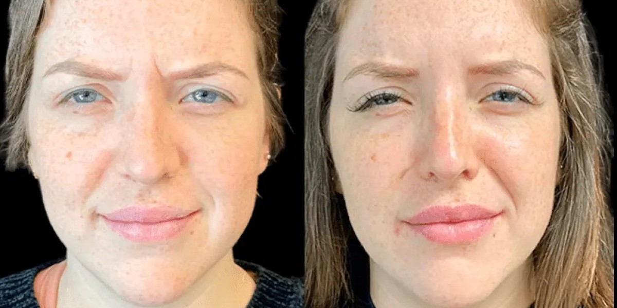 Botox Treatment in Dubai: How to Reduce Forehead Lines Effectively