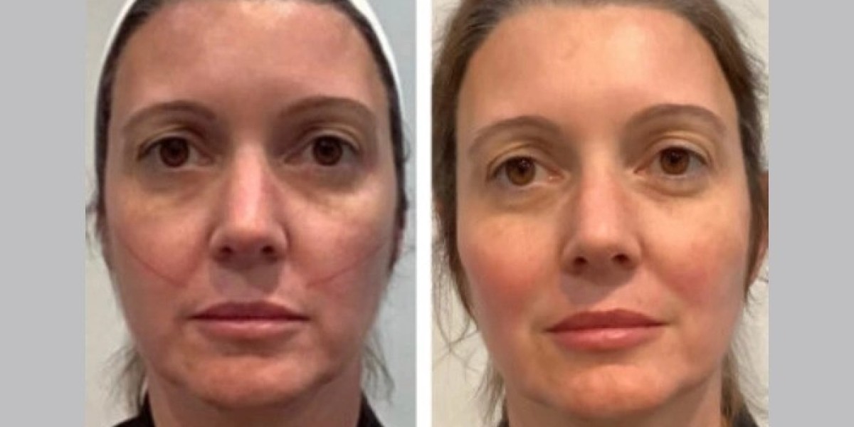 Best Aesthetic Clinic in Dubai Providing Top Quality Thread Lift Procedures