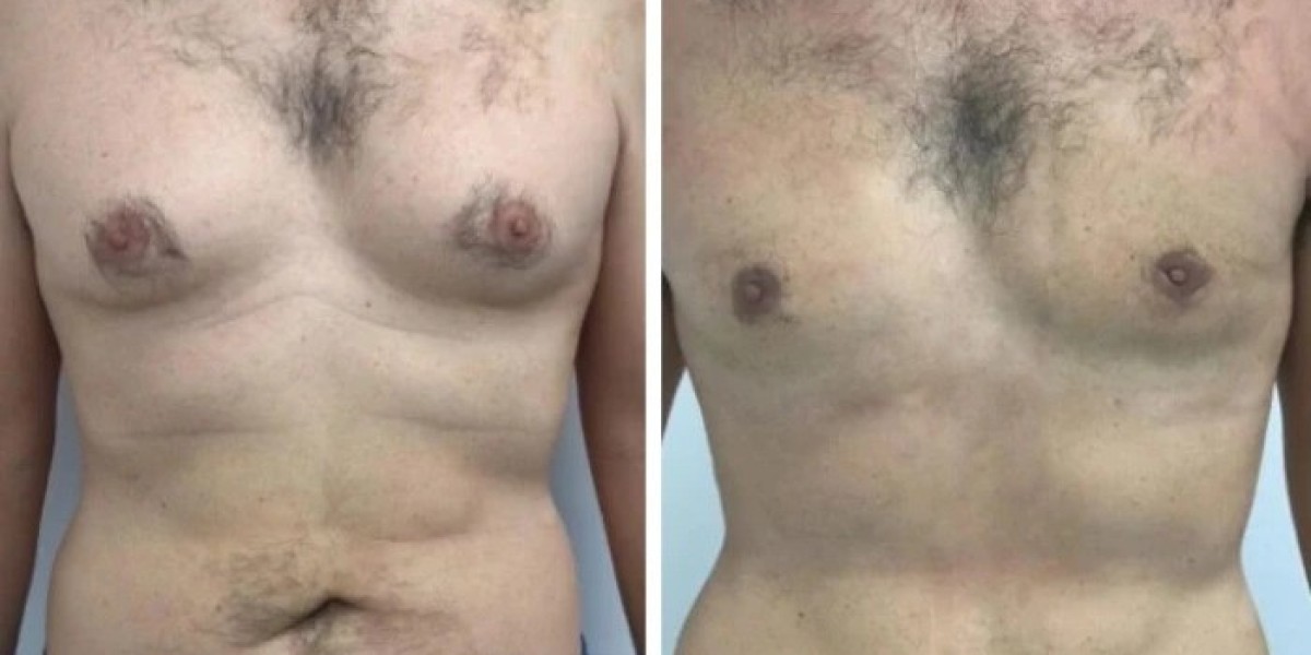 Best Gynecomastia Surgeons in Dubai: Modern Care for Better Results