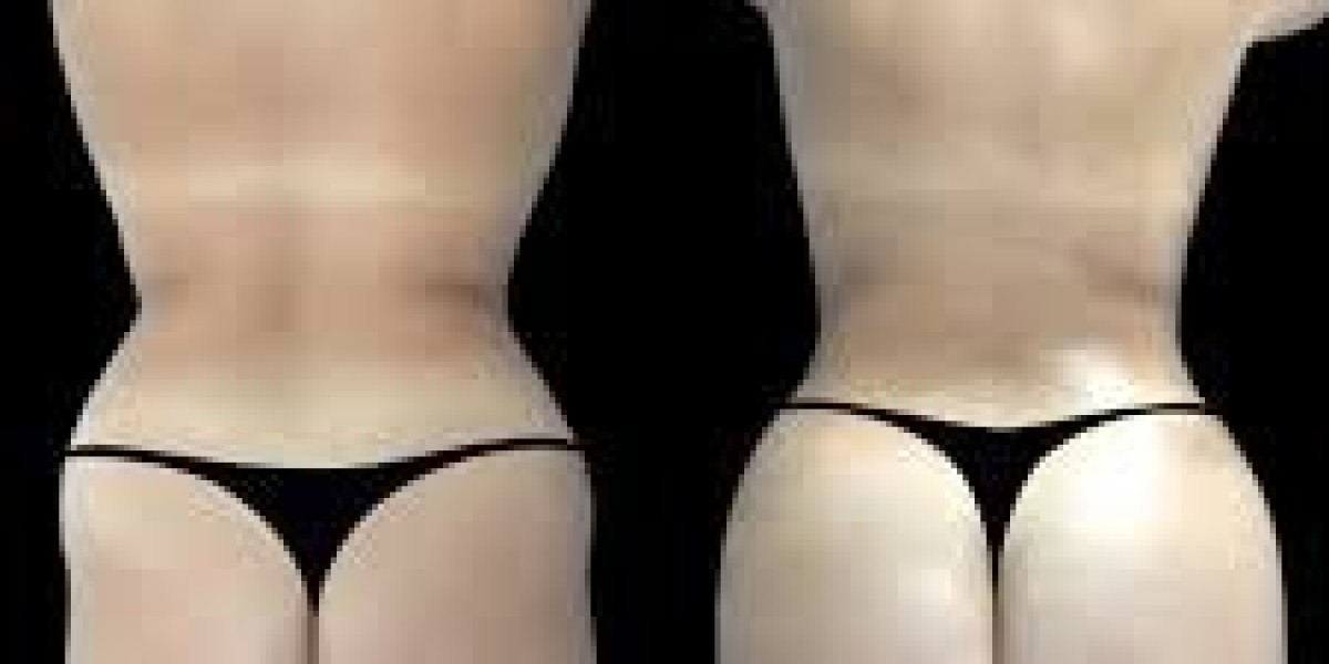 Best Butt fat transfer Surgeons in dubai: Understanding the Importance of Follow-Up Care