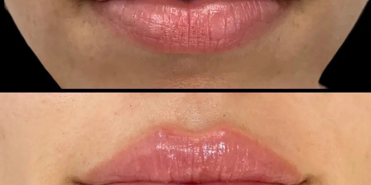 Best Aesthetic Clinic in dubai for Cost Effective Fillers