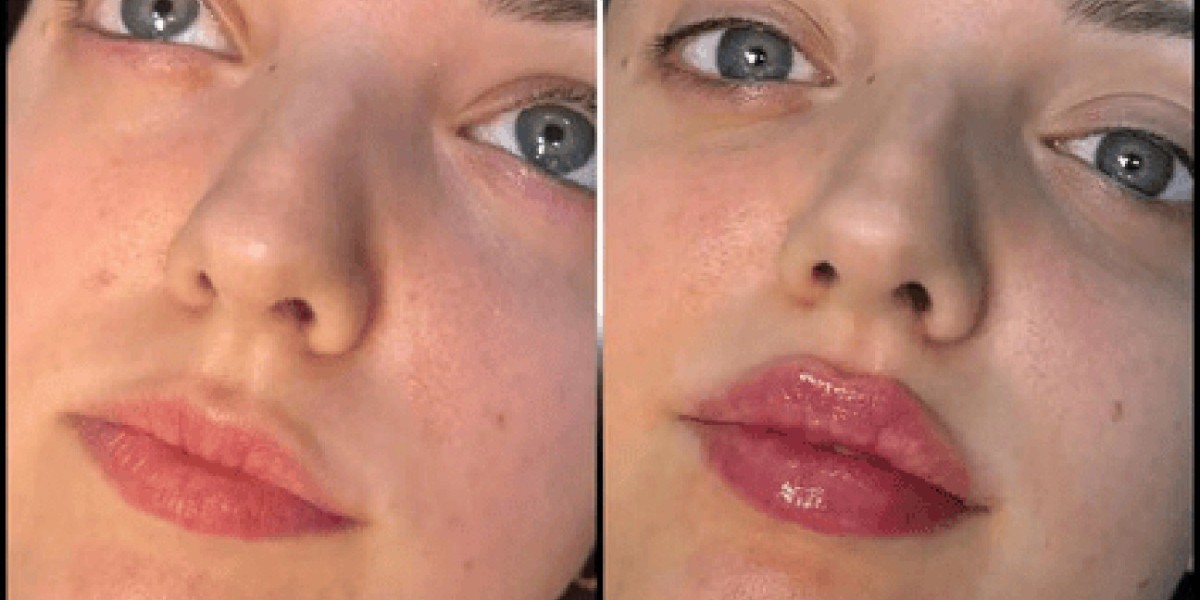 Fillers in Dubai for Fresh and Radiant Appearance