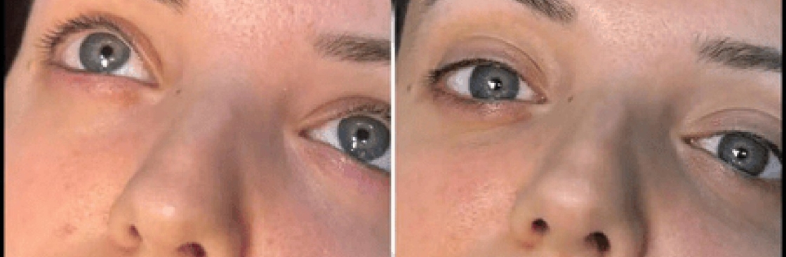 dermalfillers Cover Image