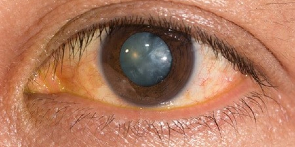 Laser Eye Surgery Pricing UK: Price of LASIK Eye Surgery and What Is Included