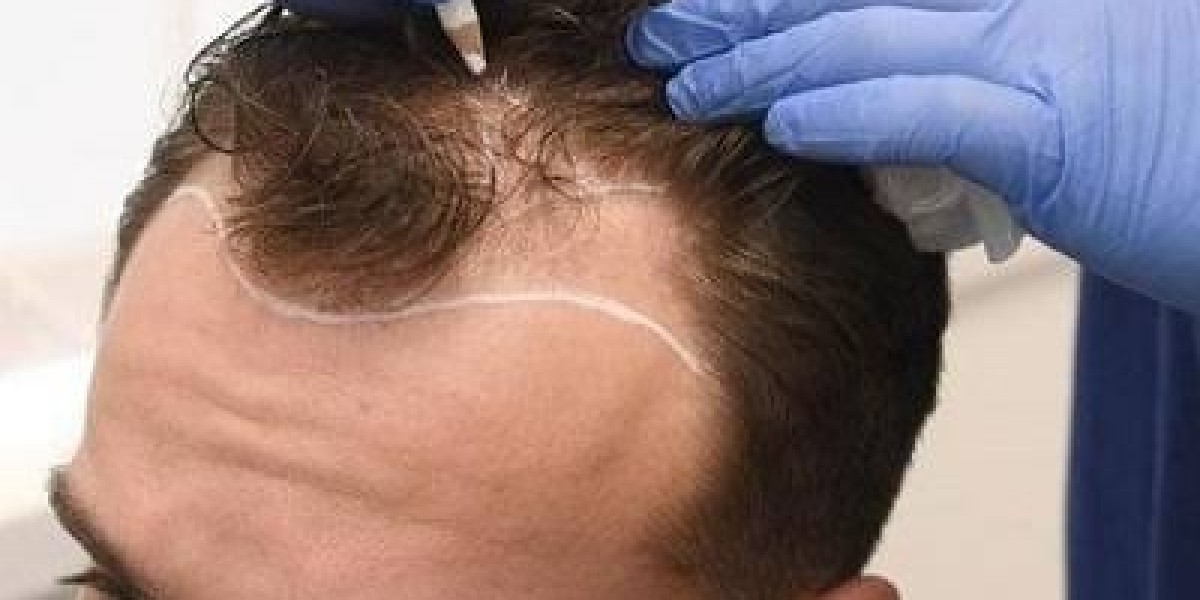 Hair Transplant in Dubai: Creating a Fuller Appearance Through Strategic Grafting
